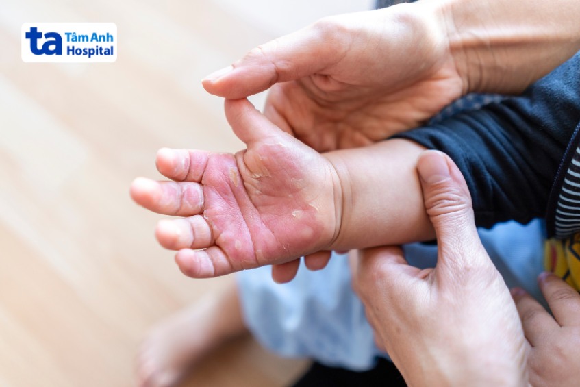 Bỏng khiến da trẻ sưng đỏ