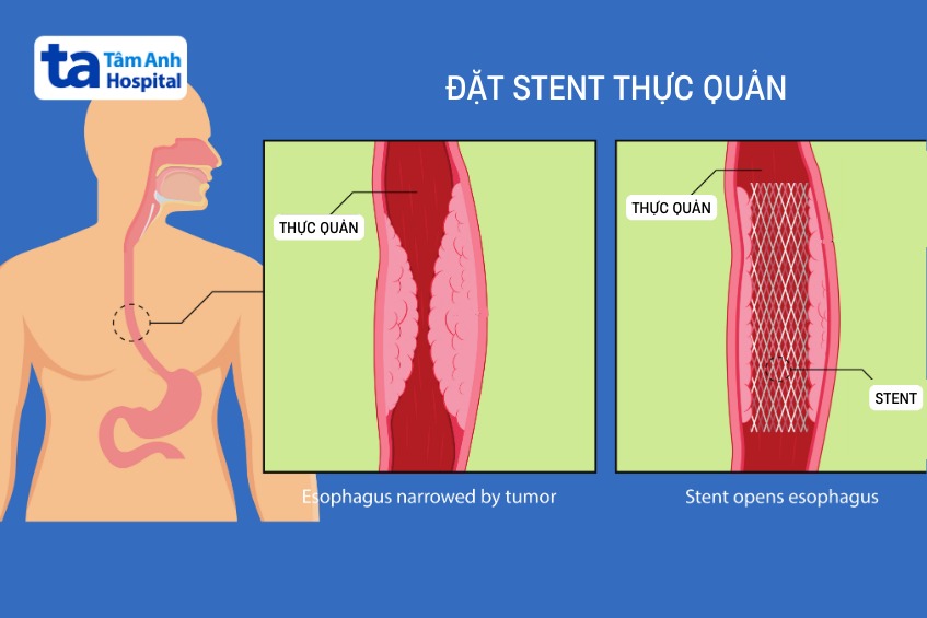 cách chữa hẹp thực quản