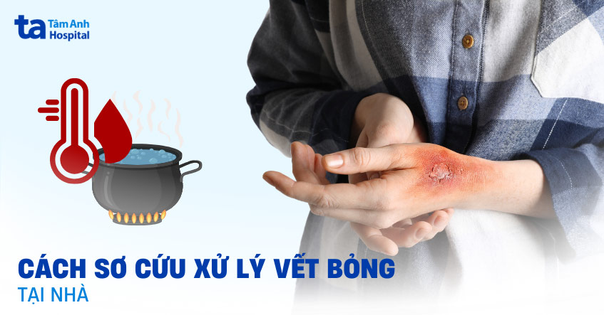 Cách sơ cứu xử lý vết bỏng tại nhà đơn giản hiệu quả dễ thực hiện
