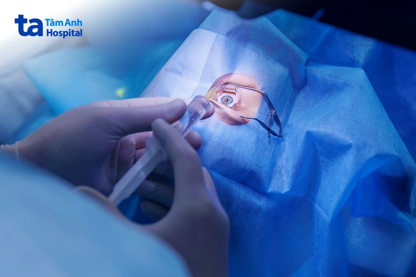 cắt dịch kính khi vẩn đục nghiêm trọng