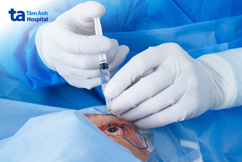 cắt dịch kính thực hiện khi có chỉ định