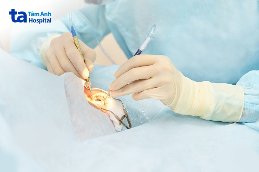 cắt dịch kính trong một số trường hợp