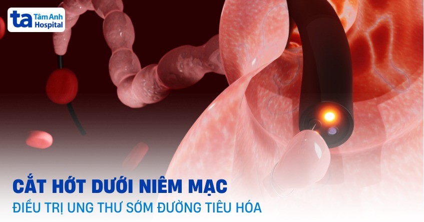 Cắt hớt dưới niêm mạc qua nội soi điều trị ung thư sớm đường tiêu hóa