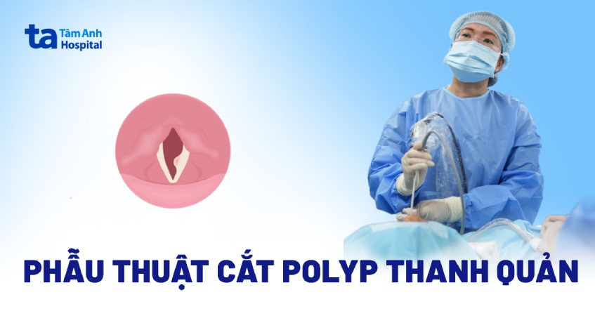 cắt polyp thanh quản