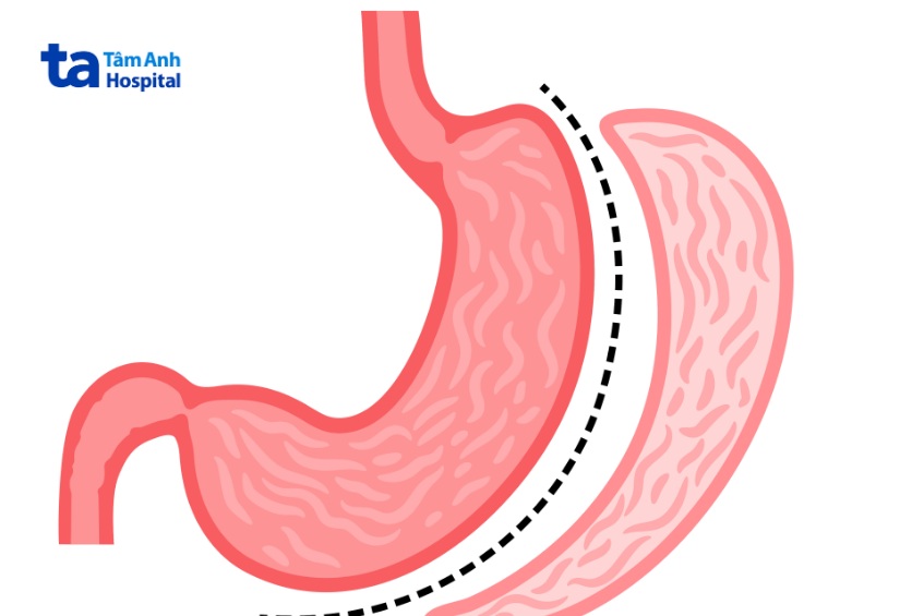 cắt thu nhỏ dạ dày
