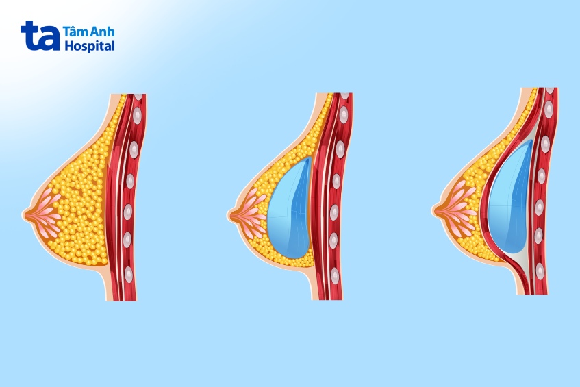 câu hỏi trước khi đặt túi ngực