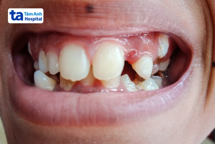 Cấu trúc răng bất thường, trẻ dễ gặp các vấn đề về răng