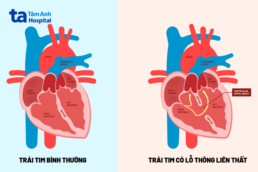 Cấu trúc tim bình thường và tim có lỗ thông liên thất