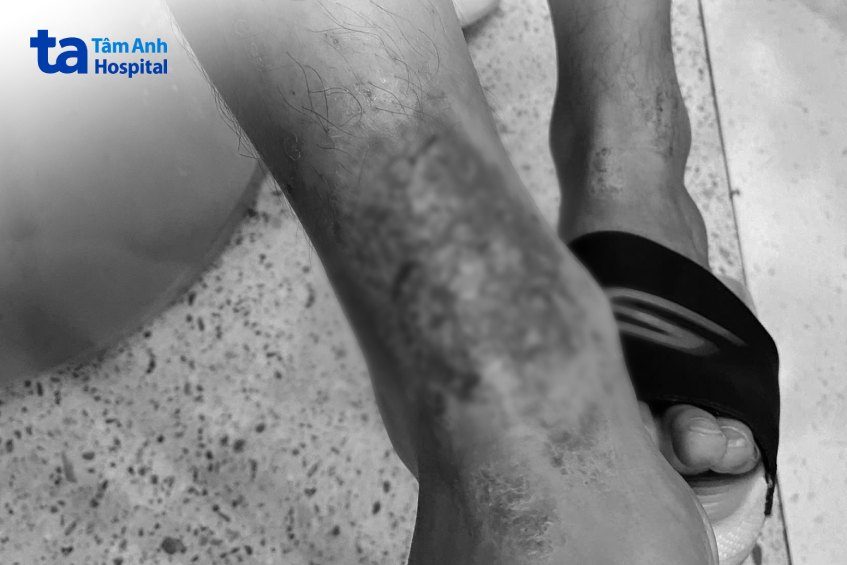chân anh b nhiễm trùng