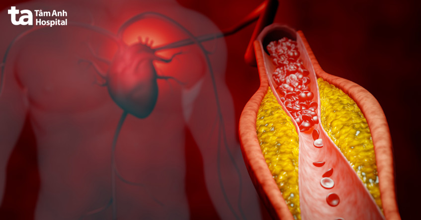 Chỉ định can thiệp mạch vành qua da cho bệnh nhân bị hẹp/tắc nghẽn động mạch vành nặng