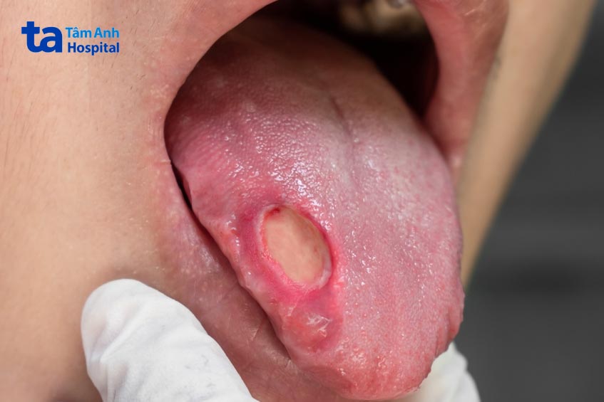 chỉ định phẫu thuật dựa vào vị trí, kích thước khối u