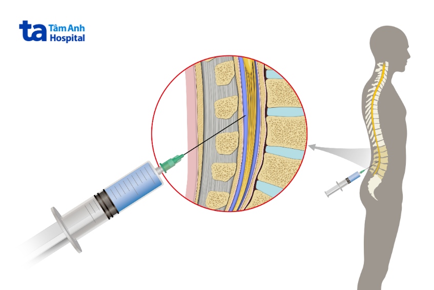 chọc tủy sống để thu thập và xét nghiệm dịch não tủy