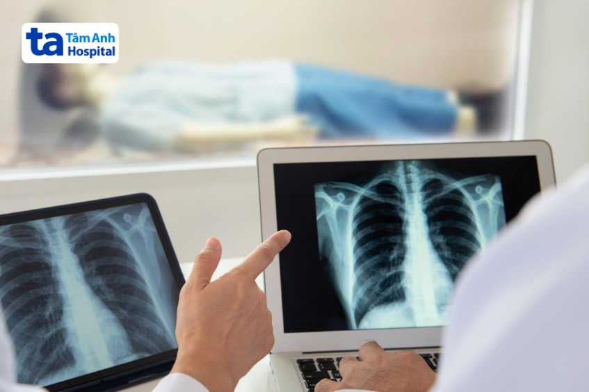 Chụp CT ngực chẩn đoán bệnh viêm mủ màng phổi