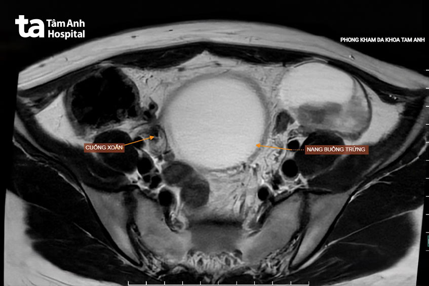 chụp mri phát hiện buồng trứng phải thùy bị xoắn