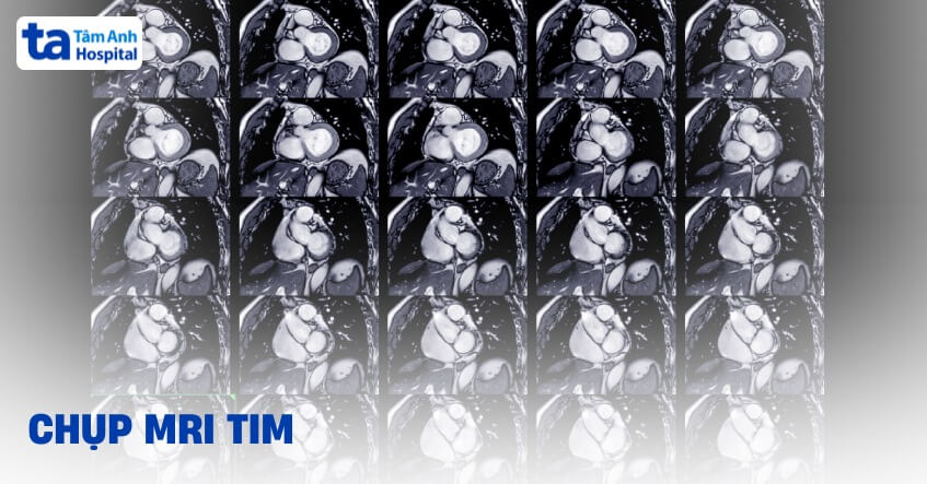 Chụp MRI tim: Khi nào cần, đối tượng và quy trình thực hiện