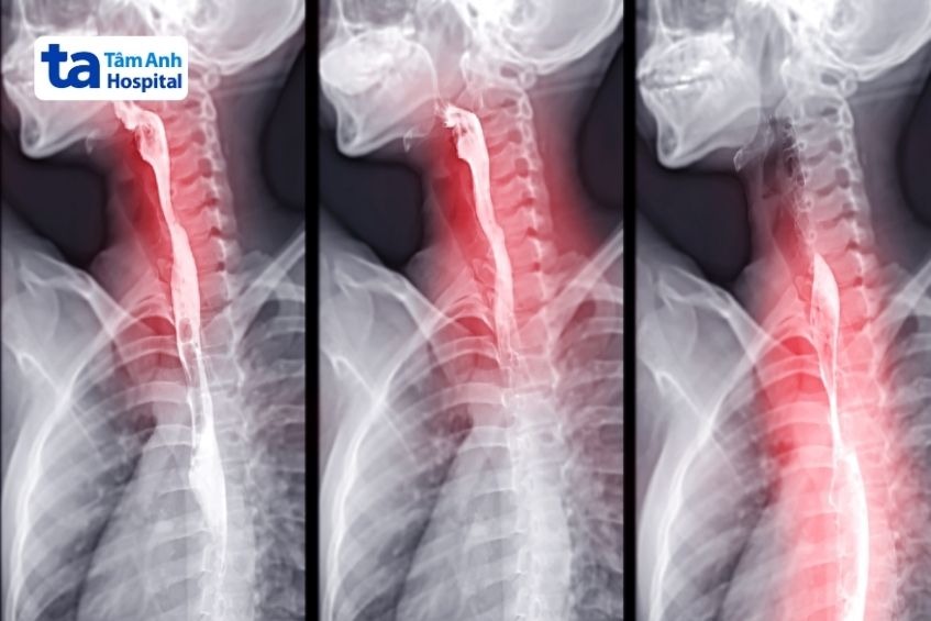 Chụp X-quang thực quản dạ dày có cản quang