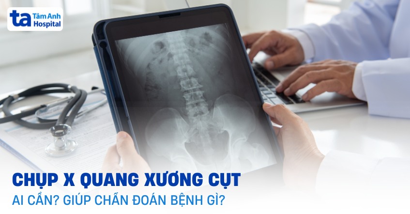 Chụp X quang xương cụt: Phát hiện bệnh gì? Quy trình thực hiện