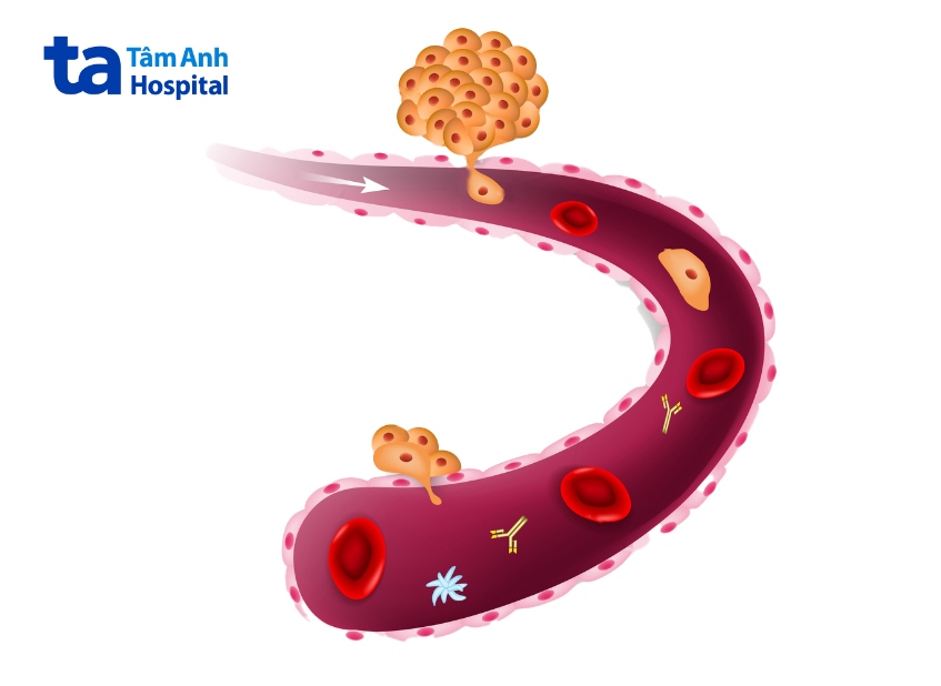 cơ chế di căn ung thư trực tràng