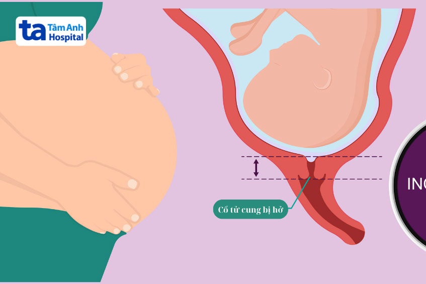 cổ tử cung bị hở gây sinh non