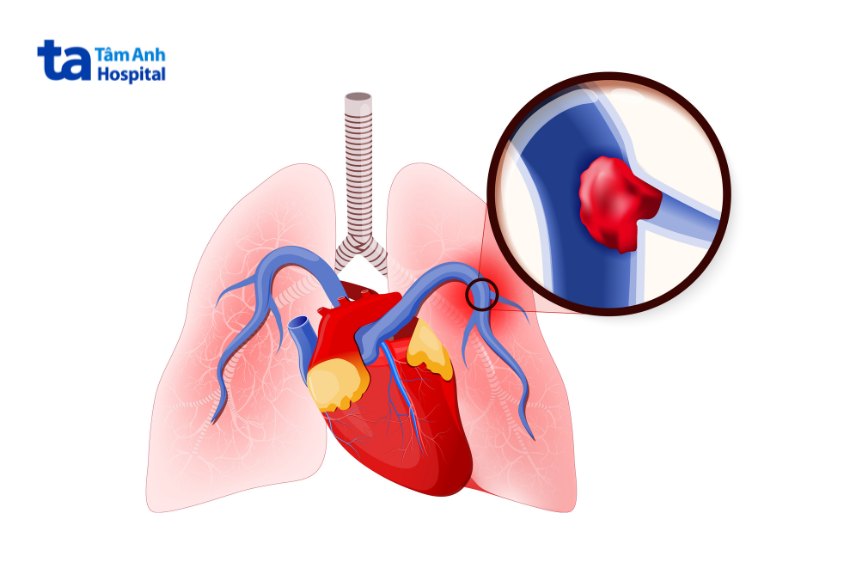 Cục máu đông chặn dòng máu đến phổi