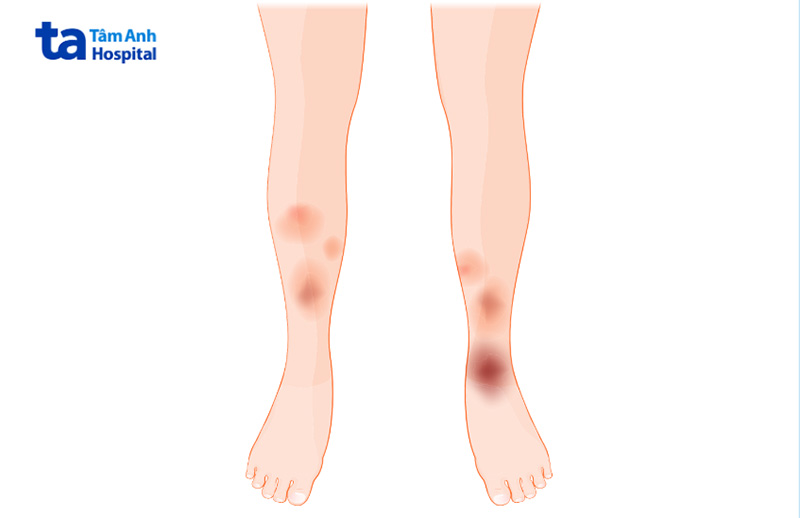 Dấu hiệu và triệu chứng của bệnh hồng ban nút