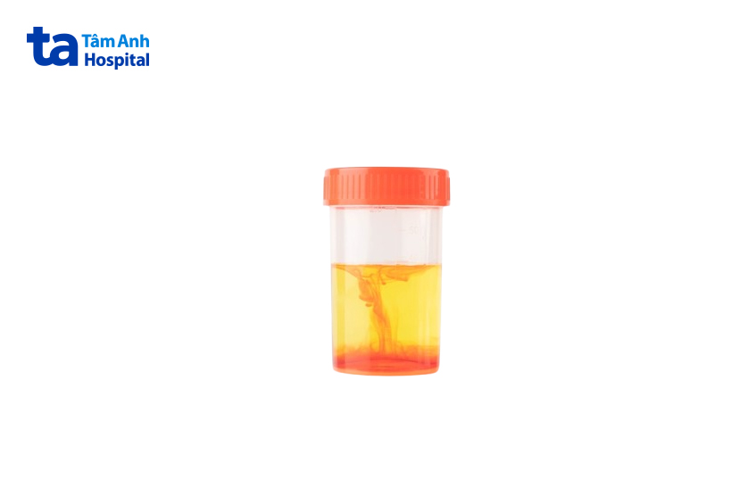 dấu hiệu ung thư bàng quang giai đoạn sớm là tiểu máu