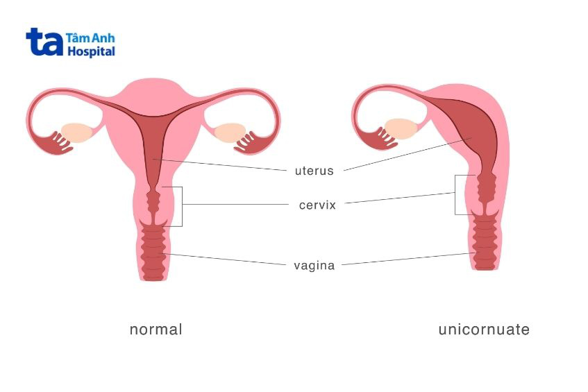 Các dị tật ở ống dẫn trứng có thể tăng nguy cơ thai ngoài tử cung sau chuyển phôi IVF