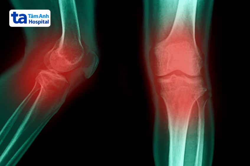 dị tật xảy ra tại cấu trúc xương chày