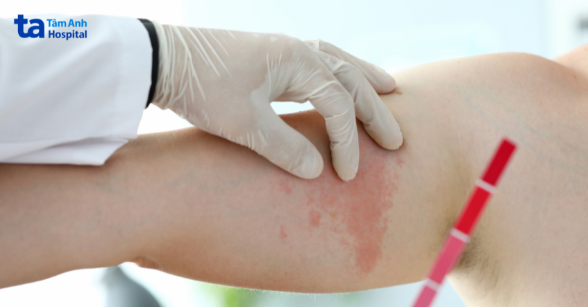 dị ứng thuốc có thể gây phát ban như nổi mề đay