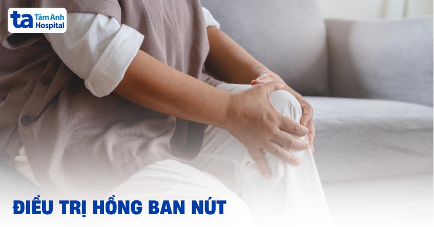 Điều trị hồng ban nút