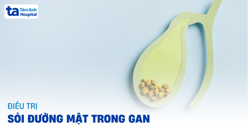 Top 3 cách điều trị sỏi đường mật trong gan phổ biến hiện nay