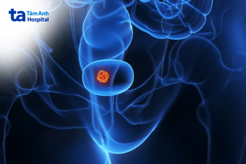 điều trị ung thư bàng quang