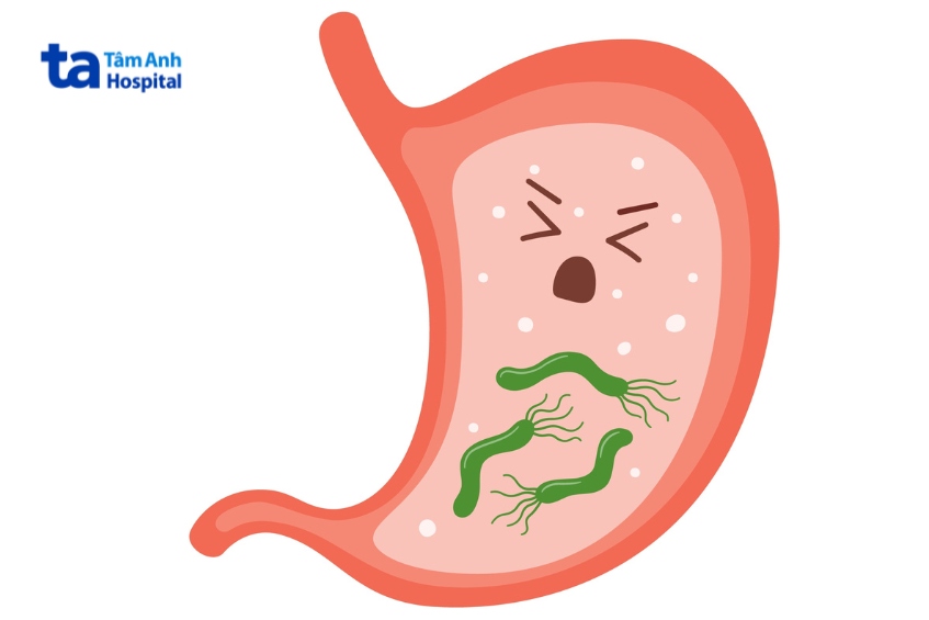 do sự tấn công của vi khuẩn Helicobacter Pylori
