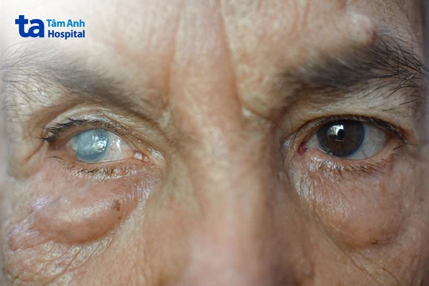 đục thủy tinh thể người già gây mù lòa