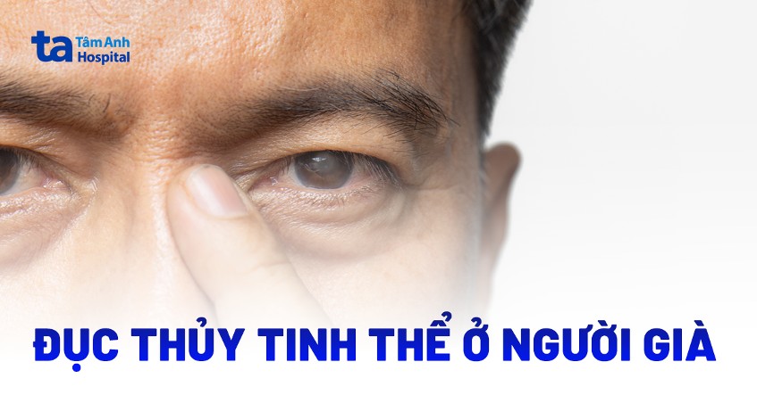 Bệnh đục thủy tinh thể ở người già (Cườm khô): Nguyên nhân, điều trị