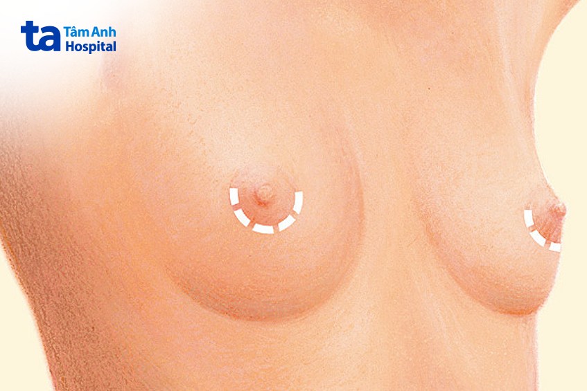 Đường mổ dọc theo rìa quầng vú