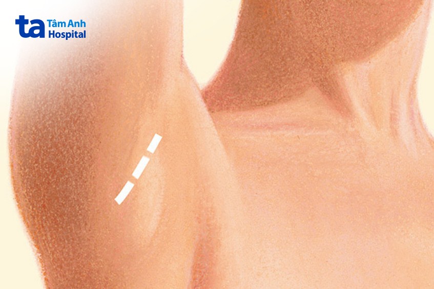 Đường mổ ở nách