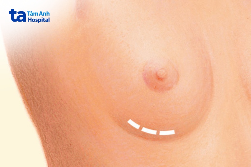 Đường mổ ở nếp gấp dưới vú