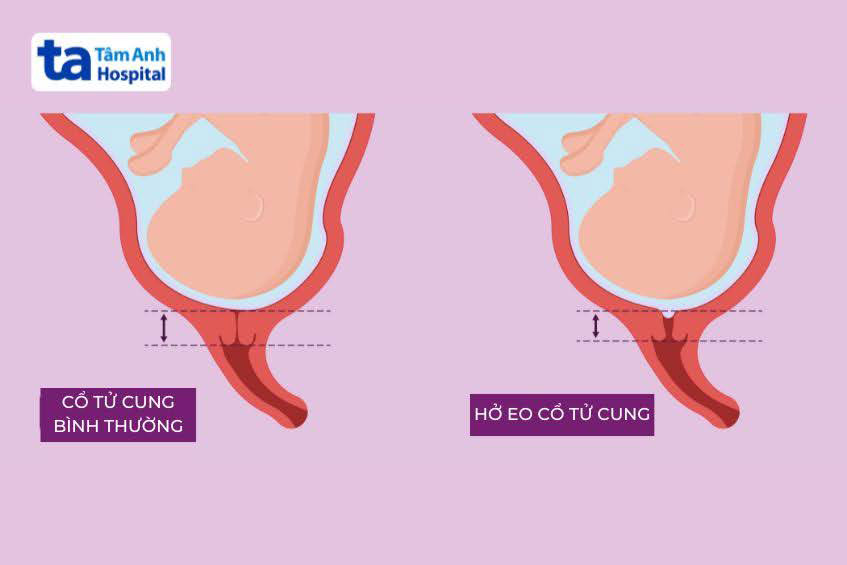 eo tử cung bị hở so với bình thường