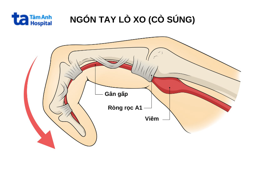 Gân gấp ngón tay là gì?