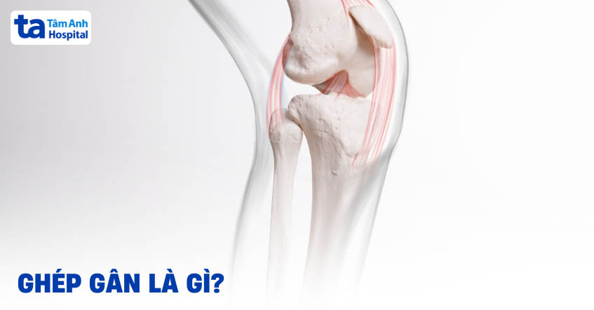 Ghép gân là gì? Quy trình, ứng dụng và nguy cơ có thể phát sinh