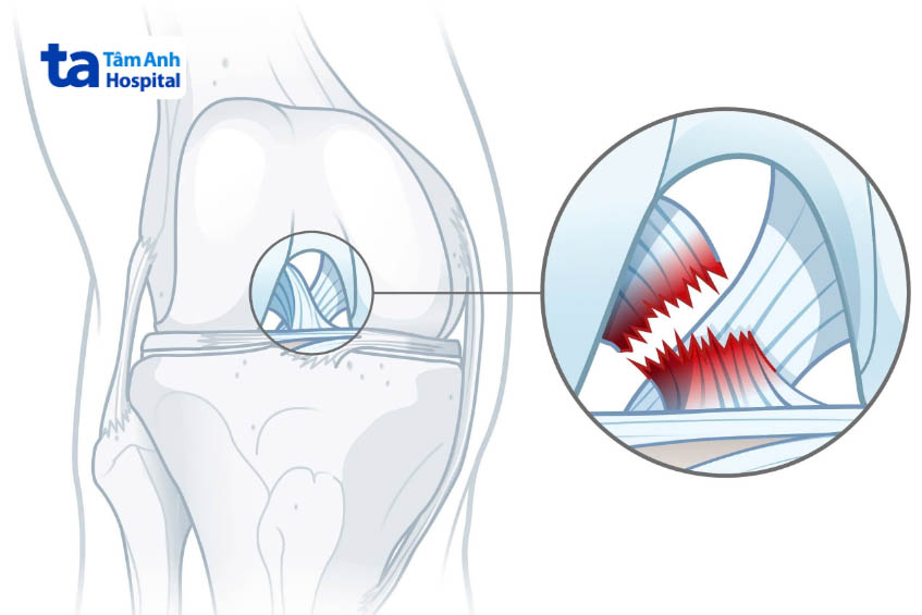 Ghép mảnh ghép thay thế gân bị tổn thương