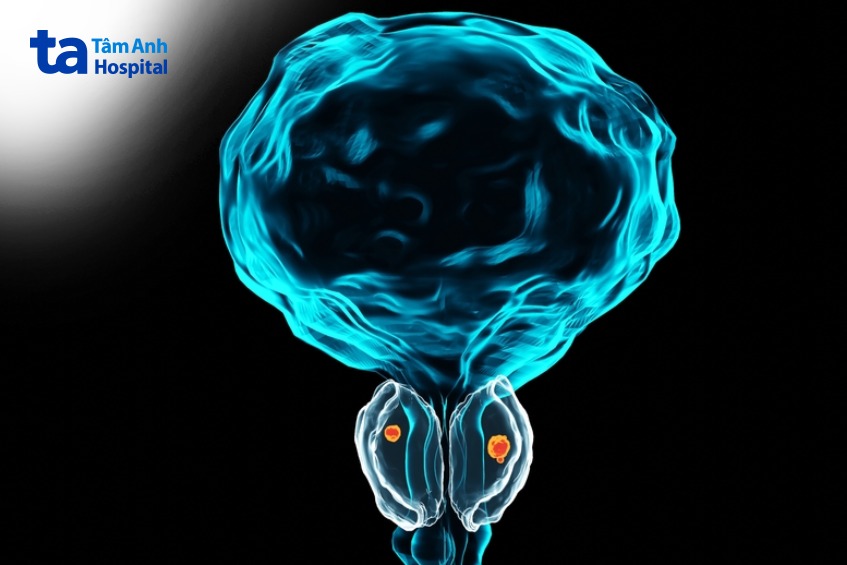 hẹp niệu đạo ở nam giới là gì