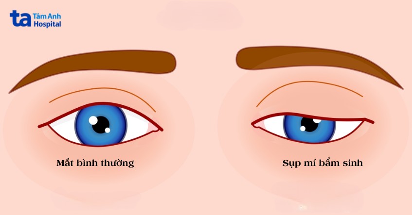 hiện tượng sụp mí bẩm sinh