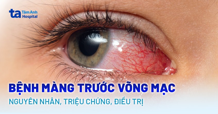 bệnh màng trước võng mạc