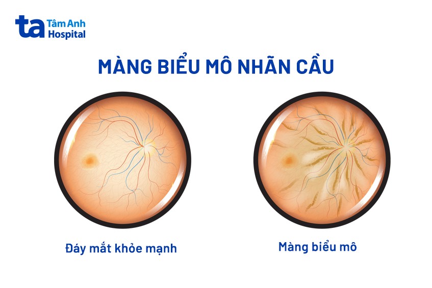 hình ảnh bệnh màng trước võng mạc