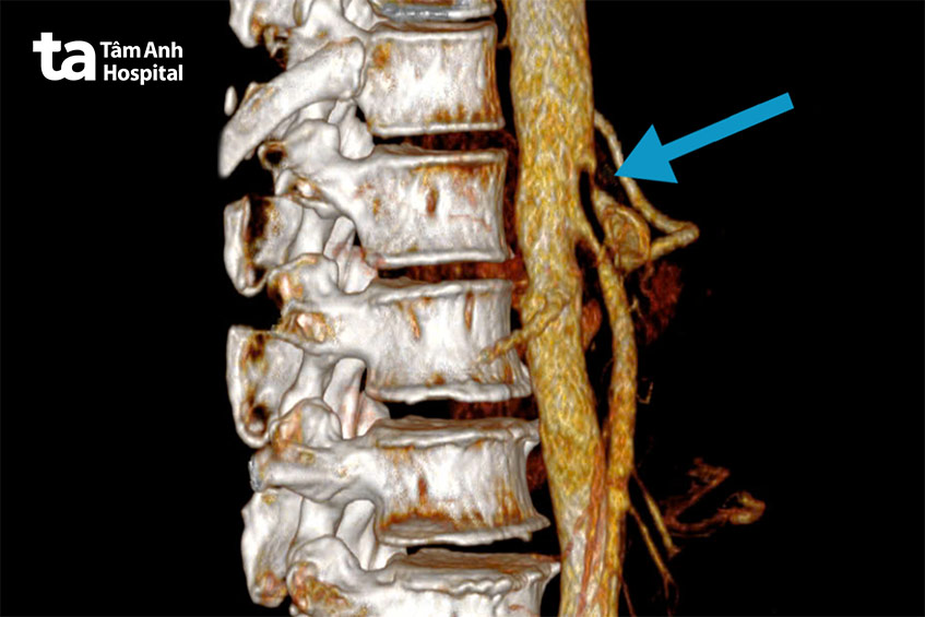 Hình ảnh dựng mạch máu 3D cho thấy hẹp gốc động mạch thân tạng