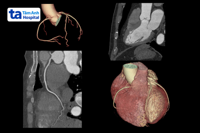 Hình ảnh giải phẫu mạch vành trên CT