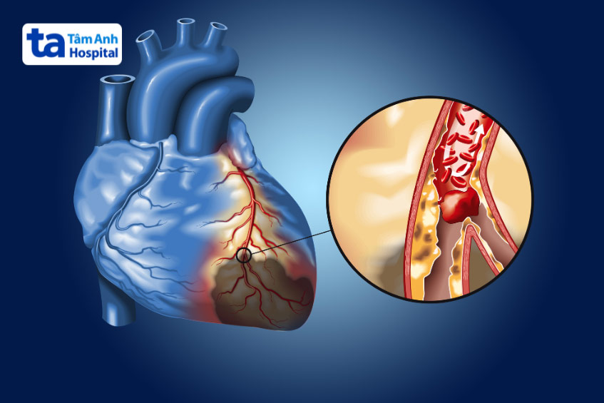 Hình ảnh các mảng xơ vữa và cục máu đông làm tắc nghẽn động mạch, nguyên nhân gây ra bệnh mạch vành