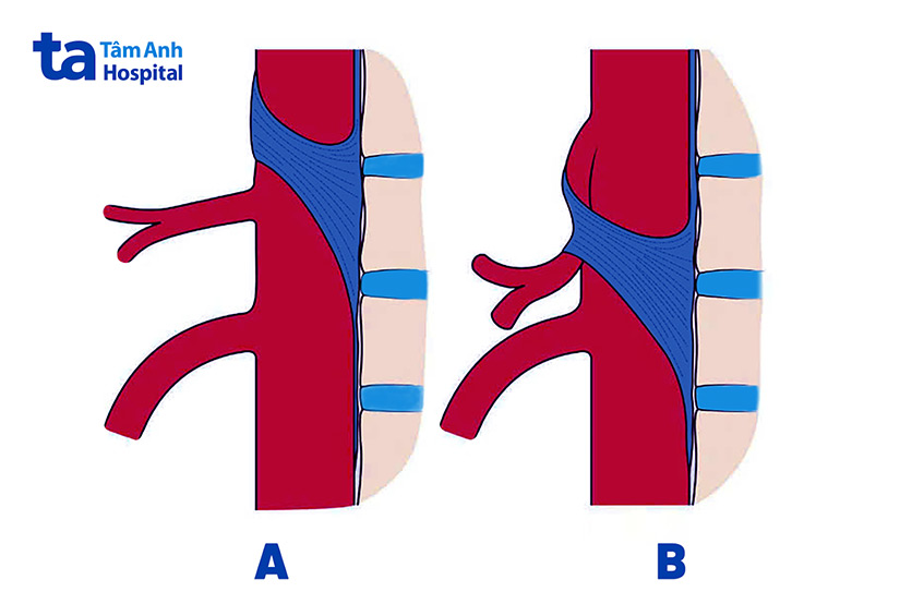 Hình ảnh minh họa dây chằng bình thường (hình A) và hội chứng dây chằng cung giữa (hình B)